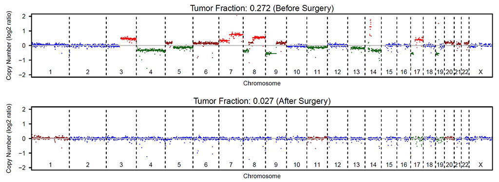 New Technology Shows Promise in Monitoring Hepatocellular Carcinoma: Circulating Genome-wide Copy Number Analysis